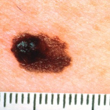 MELANOMA - LA POSITIVA Alta radiación UV: Evalúa tus lunares con la ‘regla ABCDE’